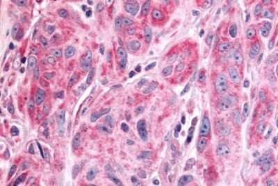 Immunohistochemistry-Paraffin: PTP epsilon Antibody [NLS6800] - Anti-PTPRE / PTP Epsilon antibody IHC of human Skin, Melanoma. Immunohistochemistry of formalin-fixed, paraffin-embedded tissue after heat-induced antigen retrieval.