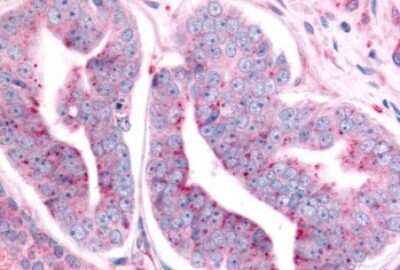 Immunohistochemistry-Paraffin: PTP epsilon Antibody [NLS6800] - Anti-PTPRE / PTP Epsilon antibody IHC of human Prostate, Carcinoma. Immunohistochemistry of formalin-fixed, paraffin-embedded tissue after heat-induced antigen retrieval.