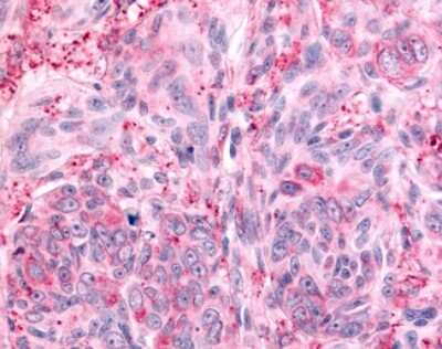 Immunohistochemistry-Paraffin: PTP epsilon Antibody [NLS6802] - Analysis of anti-PTPRE / PTP Epsilon antibody with human skin, melanoma.