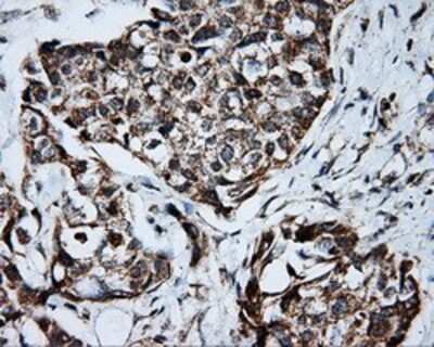 Immunohistochemistry: PTP epsilon Antibody (OTI5F2) - Azide and BSA Free [NBP2-73713] - Staining of paraffin-embedded Adenocarcinoma of breast tissue using anti-PTP epsilon mouse monoclonal antibody.