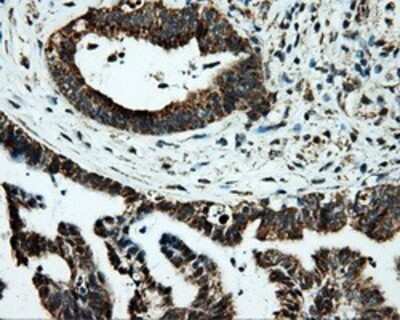 Immunohistochemistry: PTP epsilon Antibody (OTI5F2) - Azide and BSA Free [NBP2-73713] - Staining of paraffin-embedded Adenocarcinoma of colon tissue using anti-PTP epsilon mouse monoclonal antibody.