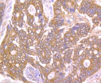 Immunohistochemistry-Paraffin: PTP1B/PTPN1 Antibody [NBP2-89139] - Analysis of paraffin-embedded human colon cancer tissue using anti-PTP1B antibody. Counter stained with hematoxylin.
