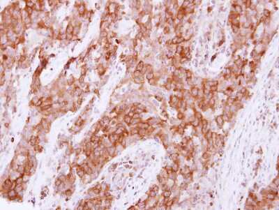 Immunohistochemistry-Paraffin: PTPD2 Antibody [NBP2-15069] - Paraffin-embedded Lung papillory AdCA, using antibody at 1:500 dilution.