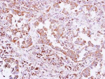 Immunohistochemistry-Paraffin: PTPD2 Antibody [NBP2-15070] - Paraffin-embedded Lung ca, using antibody at 1:500 dilution.