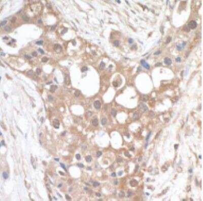 Immunohistochemistry-Paraffin: PTPIP51 Antibody [NBP1-47293] - Section of human lung carcinoma. Antibody: Affinity purified rabbit anti-PTPIP51 used at a dilution of 1:1,000 (1ug/ml) Detection: DAB
