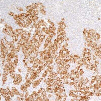 Immunohistochemistry: PTPN12 Antibody (BL-5-2F8) [NBP2-76395] - Detection of human PTPN12 in FFPE non-small cell lung carcinoma by IHC. Antibody: Rabbit anti-PTPN12 recombinant monoclonal [BL-5-2F8] (NBP2-76395). Secondary: HRP-conjugated goat anti-rabbit IgG. Substrate: DAB.