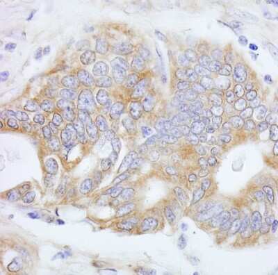 Immunohistochemistry: PTPN12 Antibody [NB100-60664] - Sample: FFPE section of human stomach carcinoma. Antibody: Affinity purified rabbit anti- PTPN12 used at a dilution of 1:200 (1ug/ml). Detection: DAB