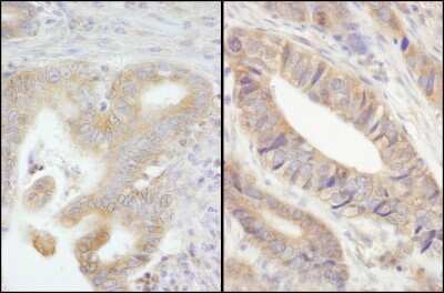 Immunohistochemistry: PTPN12 Antibody [NB100-60666] - Sample: FFPE section of human stomach carcinoma (left) and colon carcinoma (right). Antibody: Affinity purified rabbit anti- PTPN12 used at a dilution of 1:200 (1ug/ml). Detection: DAB