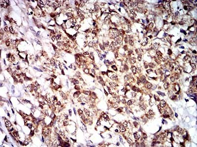 Immunohistochemistry: PTPN14/PTPD2 Antibody (2B3H7) [NBP2-61809] - Analysis of paraffin-embedded breast cancer tissues using PTPN14 mouse mAb with DAB staining.