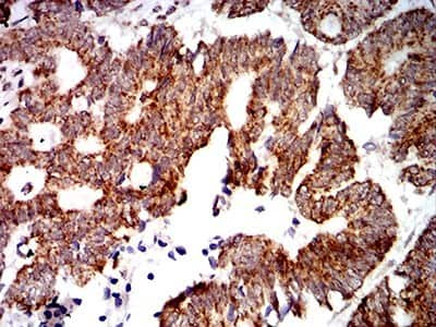 Immunohistochemistry: PTPN14/PTPD2 Antibody (2B3H7) [NBP2-61809] - Analysis of paraffin-embedded rectum cancer tissues using PTPN14 mouse mAb with DAB staining.