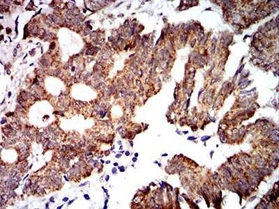 Immunohistochemistry-Paraffin: PTPN14/PTPD2 Antibody (2C12E3) [NBP2-61810] - Analysis of rectum cancer tissues using PTPN14 mouse mAb with DAB staining.