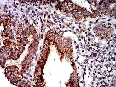 Immunohistochemistry-Paraffin: PTPN14/PTPD2 Antibody (2C12E3) [NBP2-61810] - Endometrial cancer tissues using PTPN14 mouse mAb with DAB staining.