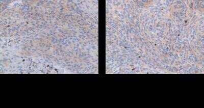 Immunohistochemistry-Paraffin: PTPN7 Antibody [NBP1-81756] - (PTPN7) at 1:100, using EDTA pre-treatment, on WHO grade I and II meningioma paraffin slides. Image from verified customer review. 