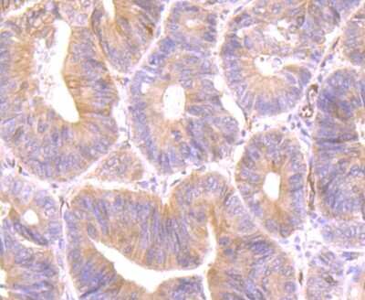 Immunohistochemistry-Paraffin: PTTG1 Antibody (JB37-37) [NBP2-75659] - Analysis of paraffin-embedded human colon cancer tissue using anti-Securin antibody. Counter stained with hematoxylin.