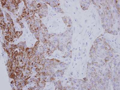 Immunohistochemistry-Paraffin: PYCR1 Antibody [NBP2-20016] - Human breast cancer, using PYCR1 antibody at 1:250 dilution. Antigen Retrieval: Trilogy™ (EDTA based, pH 8.0) buffer, 15min. 