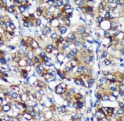 Immunohistochemistry-Paraffin: PYCR2 Antibody [NBP2-93882] - Human liver cancer using PYCR2 Rabbit pAb at dilution of 1:100 (40x lens).