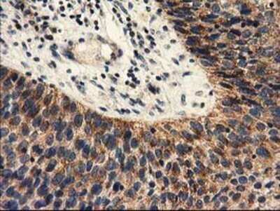 Immunohistochemistry: PYCR2 Antibody (OTI3D1) - Azide and BSA Free [NBP2-73743] - Staining of paraffin-embedded Carcinoma of Human bladder tissue using anti-PYCR2 mouse monoclonal antibody.