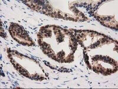 Immunohistochemistry-Paraffin: PYCRL Antibody (OTI1B12) [NBP2-03337] - Staining of paraffin-embedded Carcinoma of Human prostate tissue using anti-PYCRL mouse monoclonal antibody.