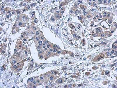 Immunohistochemistry-Paraffin: PYROXD2 Antibody [NBP2-20023] - Immunohistochemical analysis of paraffin-embedded Breast ca, using antibody at 1:500 dilution.