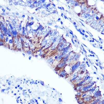 Immunohistochemistry-Paraffin: Palladin Antibody [NBP2-93983] - Paraffin-embedded human colon carcinoma using Palladin .