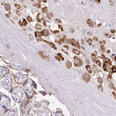 Immunohistochemistry-Paraffin: Pappalysin-2/PAPP-A2 Antibody [NBP1-87339] - Staining of human placenta shows moderate cytoplasmic positivity in trophoblastic cells.