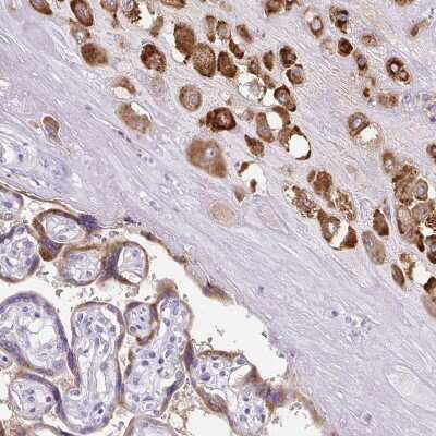 Immunohistochemistry-Paraffin: Pappalysin-2/PAPP-A2 Antibody [NBP1-87340] - Staining of human placenta shows moderate cytoplasmic positivity in trophoblastic cells.