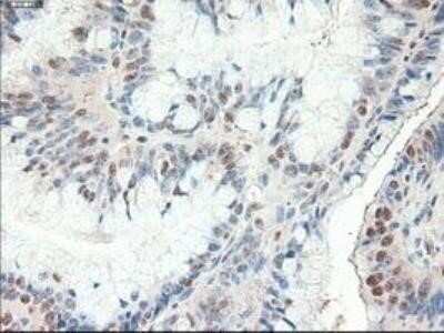 Immunohistochemistry: Patched 1/PTCH Antibody (OTI5C7) - Azide and BSA Free [NBP2-73253] - Staining of paraffin-embedded Adenocarcinoma of Human colon tissue using anti-Patched 1 mouse monoclonal antibody.