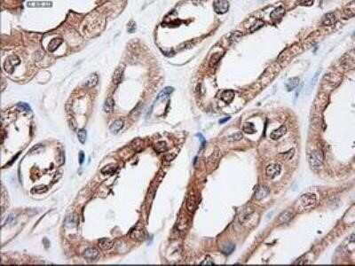 Immunohistochemistry: Patched 1/PTCH Antibody (OTI5C7) - Azide and BSA Free [NBP2-73253] - Staining of paraffin-embedded Adenocarcinoma of Human endometrium tissue using anti-Patched 1 mouse monoclonal antibody.