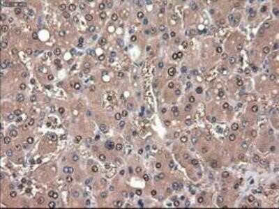 Immunohistochemistry: Patched 1/PTCH Antibody (OTI5C7) - Azide and BSA Free [NBP2-73253] - Staining of paraffin-embedded Adenocarcinoma of Human ovary tissue using anti-Patched 1 mouse monoclonal antibody.