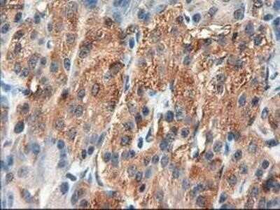 Immunohistochemistry: Patched 1/PTCH Antibody (OTI5C7) - Azide and BSA Free [NBP2-73253] - Staining of paraffin-embedded Carcinoma of Human pancreas tissue using anti-Patched 1 mouse monoclonal antibody.