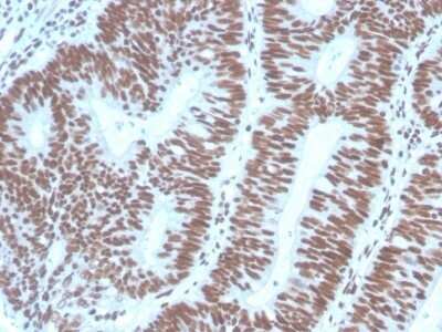 Immunohistochemistry-Paraffin: Pax2 Antibody (PAX2/1104) - Azide and BSA Free [NBP2-79877] - Formalin-fixed, paraffin-embedded human Colon Carcinoma stained with Pax2 Antibody (PAX2/1104).