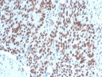 Immunohistochemistry-Paraffin: Pax2 Antibody (PAX2/1104) - Azide and BSA Free [NBP2-79877] - Formalin-fixed, paraffin-embedded human Ovarian Carcinoma stained with Pax2 Antibody (PAX2/1104).