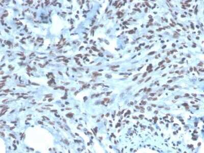 Immunohistochemistry-Paraffin: Pax2 Antibody (PAX2/1104) - Azide and BSA Free [NBP2-79877] - Formalin-fixed, paraffin-embedded human Renal Cell Carcinoma stained with Pax2 Antibody (PAX2/1104).