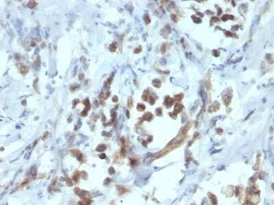 Immunohistochemistry-Paraffin: Pax6 Antibody (PAX6/1166) - Azide and BSA Free [NBP2-47915] - Human Gastric Carcinoma stained with PAX6 Monoclonal Antibody (PAX6/1166).