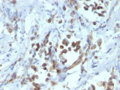 Immunohistochemistry-Paraffin: Pax6 Antibody (PAX6/1166) - IHC-Prediluted [NBP2-48246] - Formalin-fixed, paraffin-embedded human Gastric Carcinoma stained with PAX6 Monoclonal Antibody (PAX6/1166).