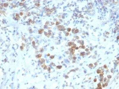 Immunohistochemistry-Paraffin: Pax6 Antibody (SPM612) - IHC-Prediluted [NBP2-48247] - Formalin-fixed, paraffin-embedded human Gastric Carcinoma stained with PAX6 Monoclonal Antibody (SPM612).