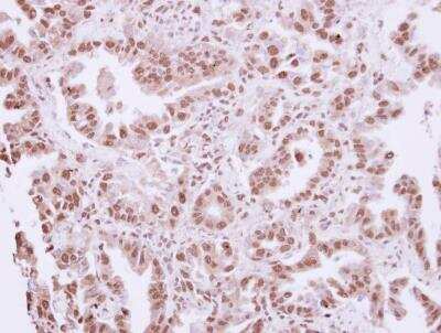 Immunohistochemistry-Paraffin: Pax7 Antibody [NBP1-31224] - Paraffin-embedded Lung AdCA, using antibody at 1:250 dilution.