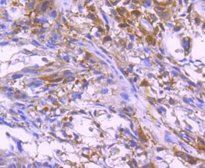 Immunohistochemistry-Paraffin: Paxillin Antibody (SY23-02) [NBP2-67427] - Analysis of paraffin-embedded human breast carcinoma tissue using anti-Paxillin antibody. Counter stained with hematoxylin.