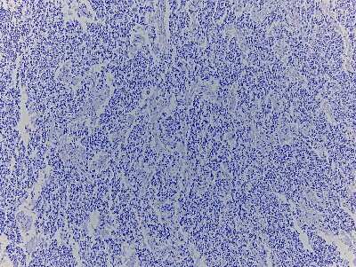 Hematoxylin & Eosin Stain: Pelvic Tissue Slides (Malignant Mesothelioma) [NBP2-77958] - Tissue: Human Pelvis,  Pathology: Malignant Mesothelioma