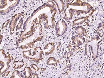 Immunohistochemistry-Paraffin: Pepsinogen A Antibody [NBP3-00065] - Immunochemical staining of human Pepsinogen A in human gastric cancer with rabbit polyclonal antibody (1:5000, formalin-fixed paraffin embedded sections).