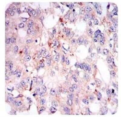 Immunohistochemistry: Perilipin-2/ADFP Antibody (2C5A3) - Azide and BSA Free [NBP2-80907] - Analysis of ADFP in paraffin-embedded human esophageal cancer tissues with DAB staining. Image from the standard format of this antibody.