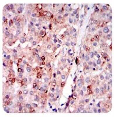 Immunohistochemistry-Paraffin: Perilipin-2/ADFP Antibody (2C5A3) - Azide and BSA Free [NBP2-80907] - Analysis of ADFP in paraffin-embedded human liver cancer tissues with DAB staining. Image from the standard format of this antibody.