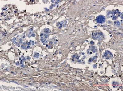 Immunohistochemistry-Paraffin: Periostin/OSF-2 Antibody (S03-7E3) [NBP3-20049] - Immunohistochemistry of Periostin/OSF-2 in paraffin-embedded Human Cholangiocarcinoma using NBP3-20049 at dilution 1/50