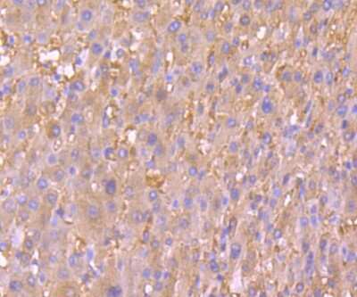Immunohistochemistry-Paraffin: Peroxiredoxin 2 Antibody (7F2) [NBP2-75613] - Analysis of paraffin-embedded human liver cancer tissue using anti- Peroxiredoxin 2 antibody. Counter stained with hematoxylin.