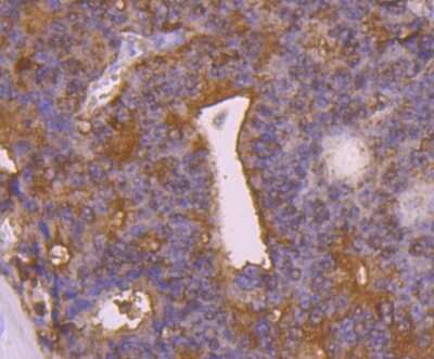Immunohistochemistry-Paraffin: Peroxiredoxin 2 Antibody (7F2) [NBP2-75613] - Analysis of paraffin-embedded human prostate cancer tissue using anti- Peroxiredoxin 2 antibody. Counter stained with hematoxylin.
