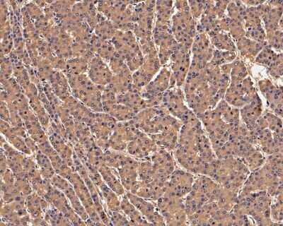 Immunohistochemistry-Paraffin: Peroxiredoxin 2 Antibody (7F4) [NBP2-75614] - Analysis of paraffin-embedded human liver carcinoma tissue with Mouse anti-PRDX2 antibodyEM1701-71) at 1/200 dilution. The section was pre-treated using heat mediated antigen retrieval with Tris-EDTA buffer (pH 9.0) for 20 minutes. The tissues were blocked in 1% BSA for 20 minutes at room temperature, washed with ddH2O and PBS, and then probed with the primary antibodyEM1701-71) at 1/200 dilution for 1 hour at room temperature. The detection was performed using an HRP conjugated compact polymer system. DAB was used as the chromogen. Tissues were counterstained with hematoxylin and mounted with DPX.