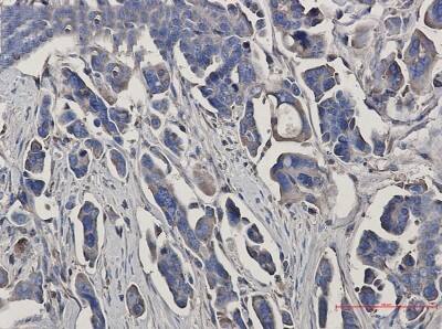 Immunohistochemistry-Paraffin: Peroxiredoxin 3 Antibody (S07-3I3) [NBP3-19906] - Immunohistochemistry of Peroxiredoxin 3 in paraffin-embedded Human Cholangiocarcinoma using NBP3-19906 at dilution 1/50