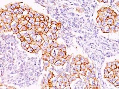 Immunohistochemistry-Paraffin: Phospho-Tyrosine Antibody (PY20) - Azide and BSA Free [NBP2-33166] - Formalin-fixed, paraffin-embedded breast carcinoma stained with Phosphotyrosine Ab (PY20). Note cell surface and cytoplasmic staining.