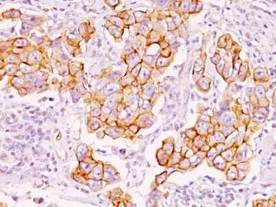 Immunohistochemistry-Paraffin: Phospho-Tyrosine Antibody (PY793) - Azide and BSA Free [NBP2-34730] - Human Breast Carcinoma stained with Phosphotyrosine Monoclonal Antibody (PY793).