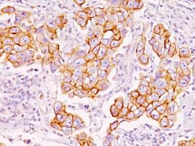 Immunohistochemistry-Paraffin: Phospho-Tyrosine Antibody (PY793) [NBP2-45213] - Human Breast Carcinoma stained with Phosphotyrosine Monoclonal Antibody (PY793).